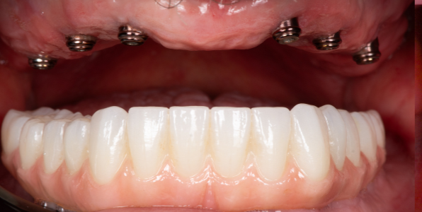StarBrite patient case 3 before treatment