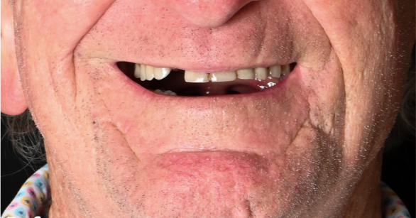 StarBrite patient case 4 before treatment