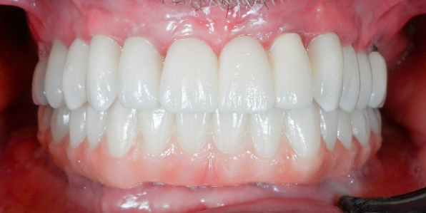 StarBrite patient case 3 after treatment