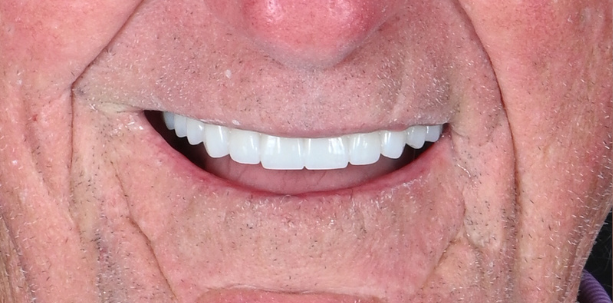 StarBrite patient case 4 after treatment
