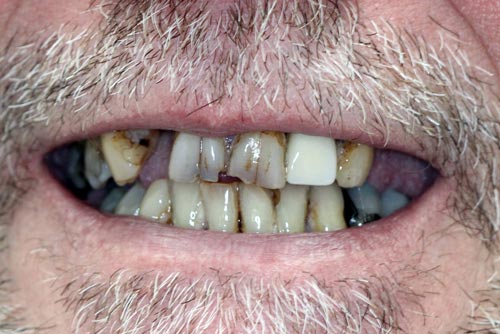 StarBrite patient case 1 before treatment