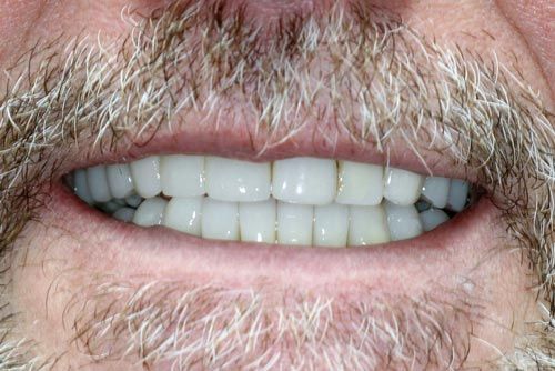 StarBrite patient case 1 after treatment