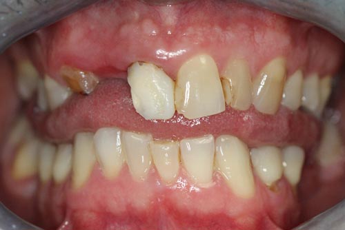 StarBrite patient case 2 before treatment