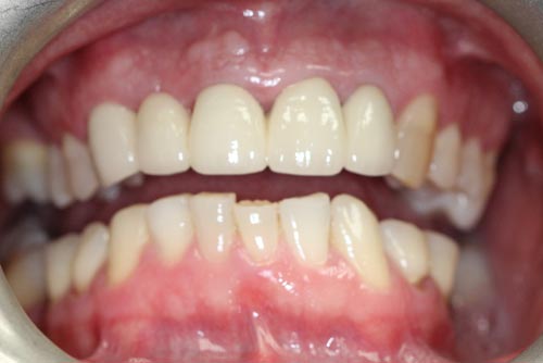 StarBrite patient case 2 after treatment
